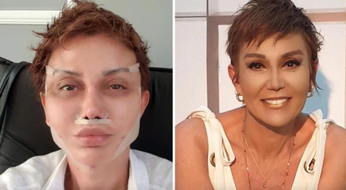 Serap Paköz'ün bandajları çıktı! Ünlü sunucu yeni halini paylaştı